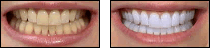 Teeth Whitening Before and After Pictures