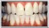 Genetic Stains After Applying Teeth Whitening Gel by Brighter Image